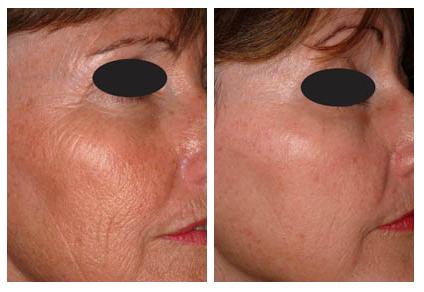 Rejuvenecimiento-facial-laser-co2