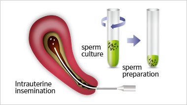 intrauterineinsemination